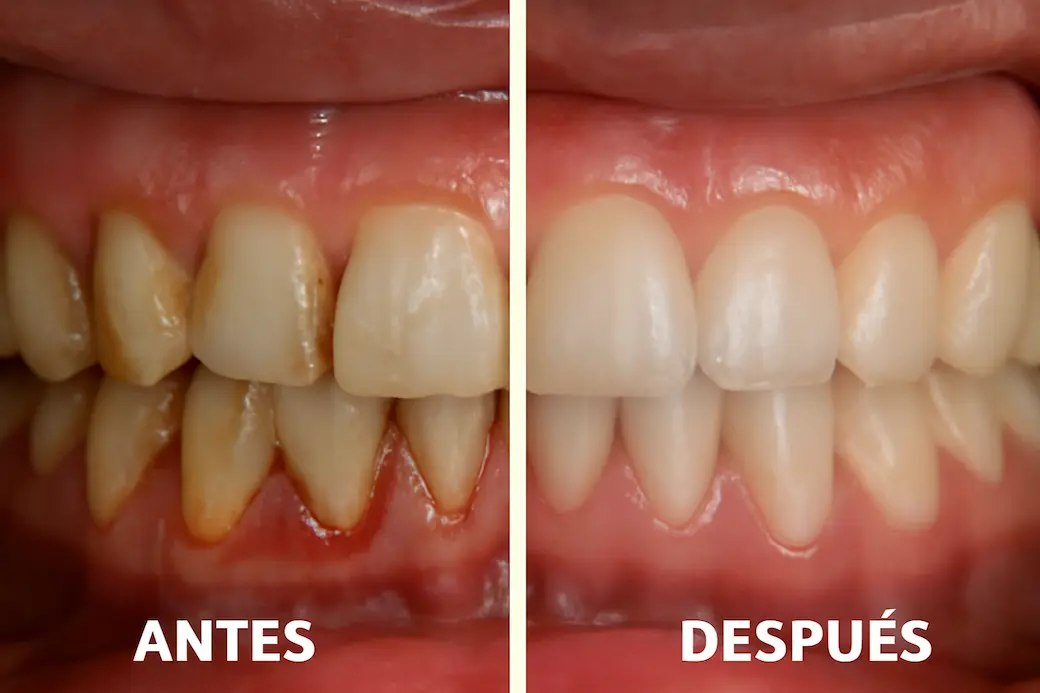 Antes y después de un curetaje dental
