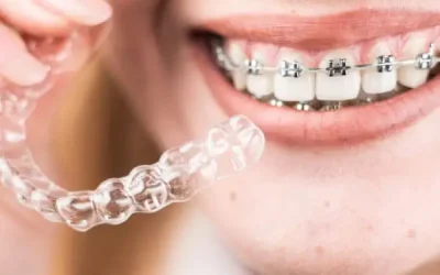 Brackets o Invisalign: ¿qué ortodoncia elegir?