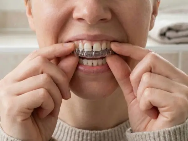 Persona colocándose un alineador transparente de ortodoncia sobre los dientes